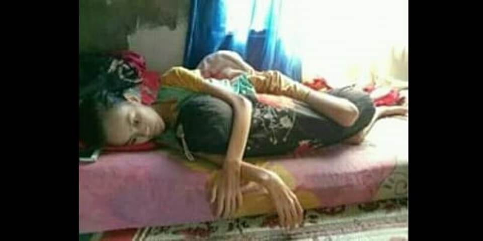 Butuh Uluran Tangan, Gadis Asal Bengkulu Ini Idap Tumor di Usus