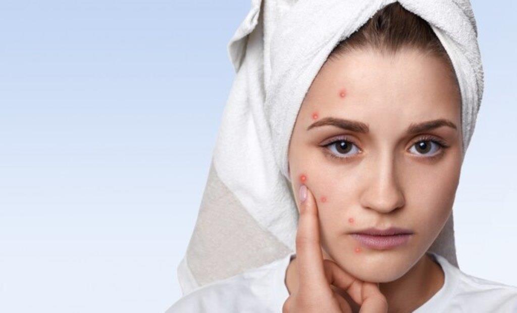 Wajah Breakout Ternyata Ini 3 Penyebabnya