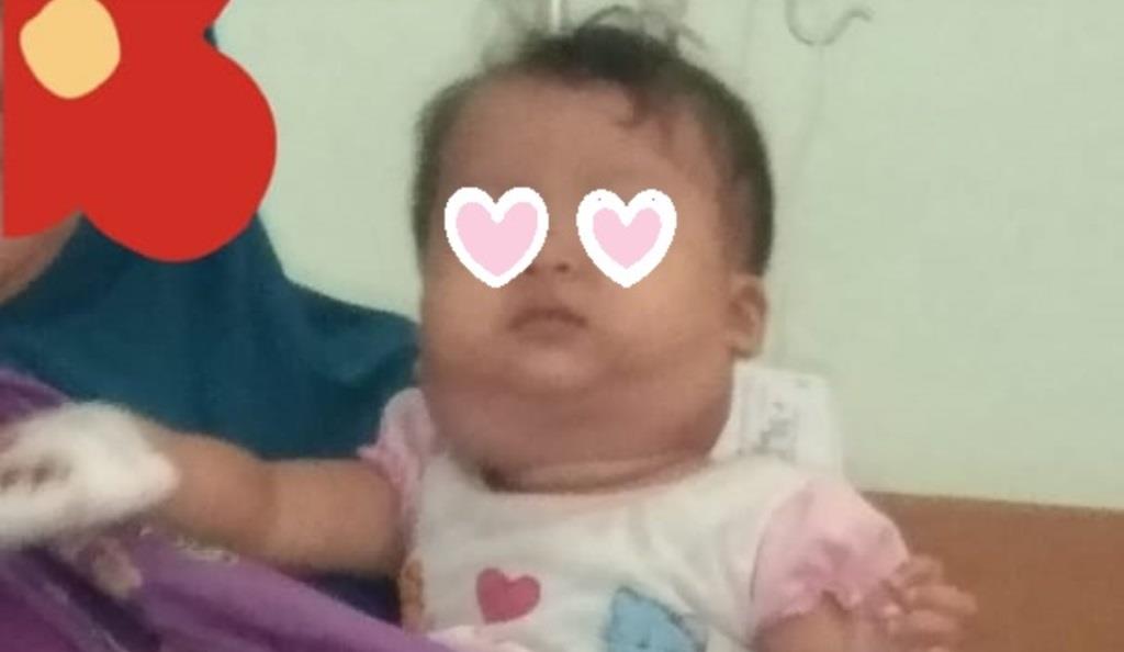 Didiagnosa Sakit Kelenjar Getah Bening, Bayi Berumur 11 Bulan di Seluma Butuh Uluran Tangan